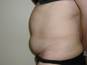 Tummy Tuck - Case 0106 - before side view