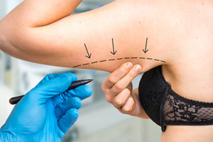 medical professional drawing surgical lines on woman's arm