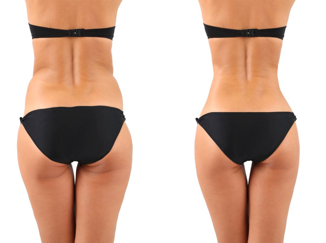Body Contouring vs Liposuction