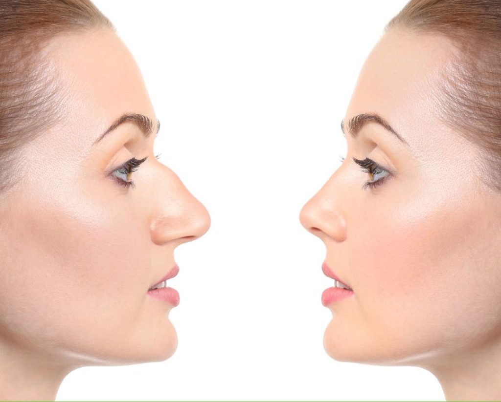 Rhinoplasty, Plastic Surgery, NYC