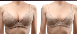 Dr. Scot Glasberg, breast reduction surgery