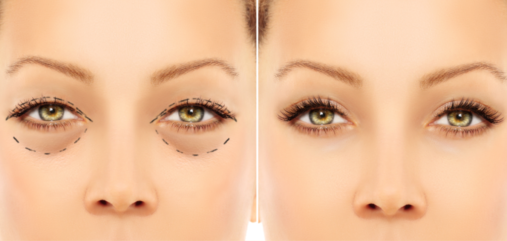 Lower eyelid blepharoplasty.Upper blepharoplasty