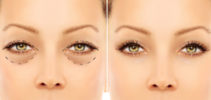 Lower eyelid blepharoplasty.Upper blepharoplasty