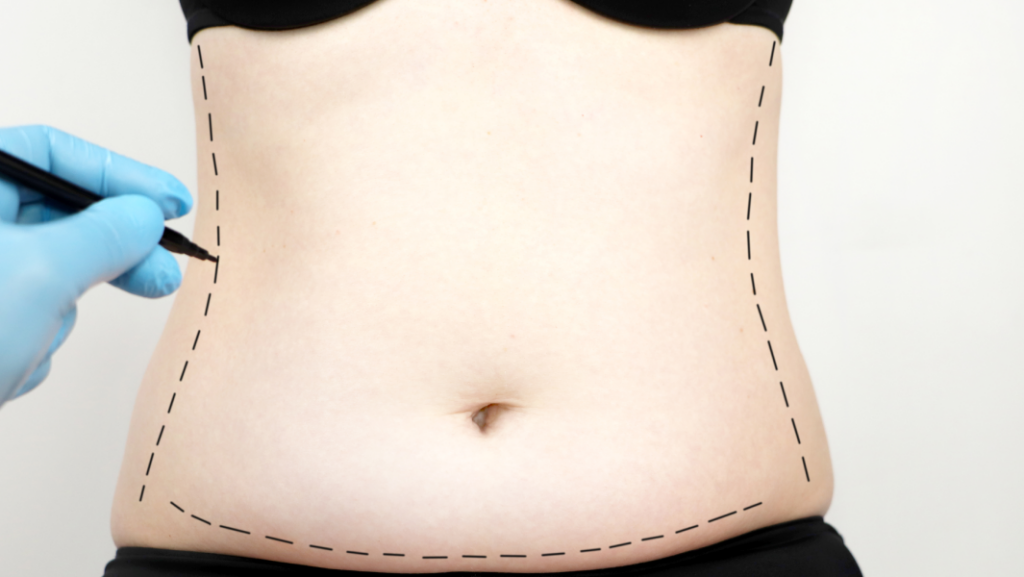Abdominoplasty, Tummy Tuck