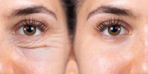 Blepharoplasty