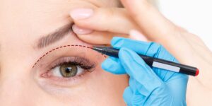 Upper Eyelid Lift