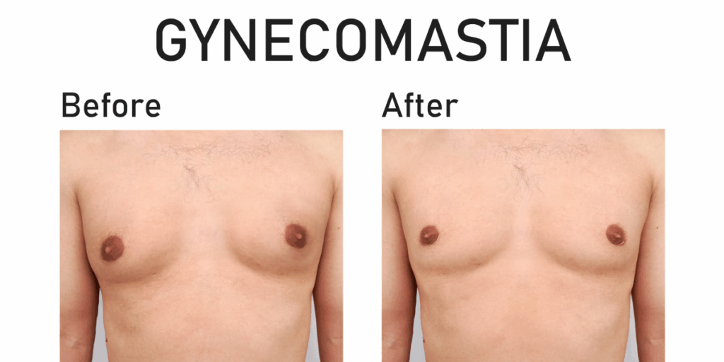 Gynecomastia