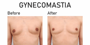 Gynecomastia