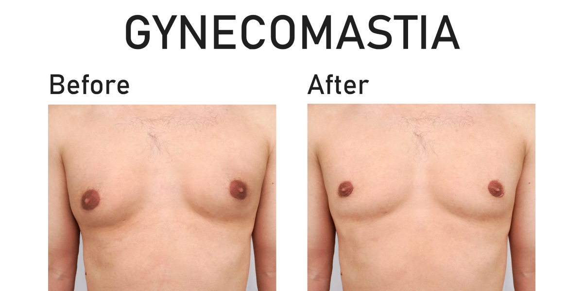 Gynecomastia